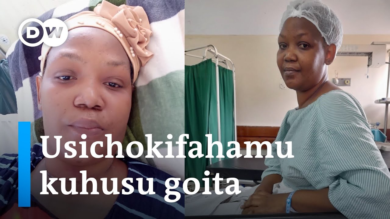 Fahamu ugonjwa wa goita na madhara yake