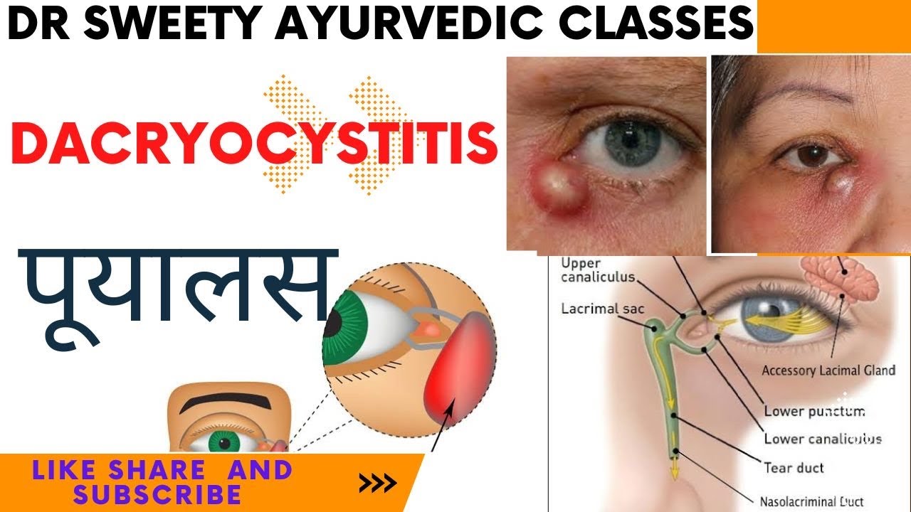 Dacryocystitis || Shalakya tantra || पूयालस || Dr Sweety || 