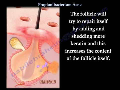 Acne explained ,Propionibacterium Acne - Everything You Need To Know - Dr. Nabil Ebraheim