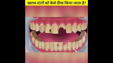 खराब दांतों को कैसे ठीक किया जाता  है।#fardeenfacts/#shorts/ animation fcats
