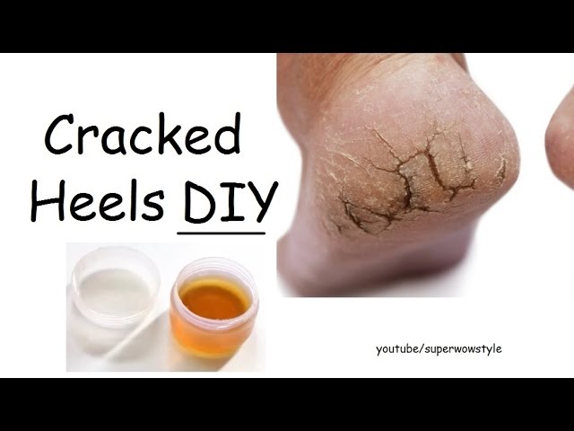 Heal Cracked Feet, Hydrate Those Tired Feet With These DIY Foot Cream  Recipes | HerZindagi