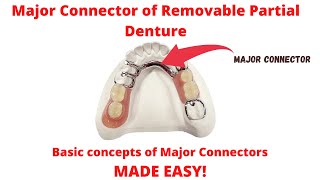 Major Connectors of Removable Partial Denture