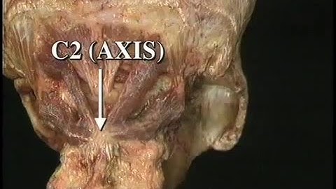 Treating Suboccipital Pain