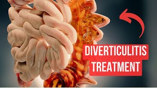 How To Treat Diverticulitis in 2024