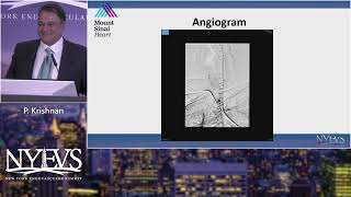 Case Presentation 2 Carotid Complication   P  Krishnan   PAD Session