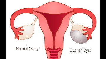 CPT code for Cystectomy partial - simplify medical coding