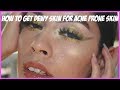 HOW TO GET DEWY SKIN ON ACNE PRONE SKIN | Rocio Ceja