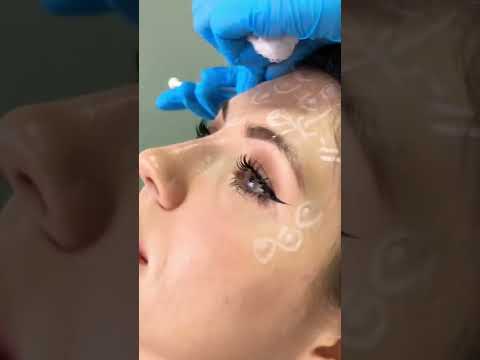 Vídeo: Vou fazer botox na minha consulta?