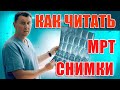 МРТ позвоночника - как читать снимки?|Нейрохирург Александр Печиборщ