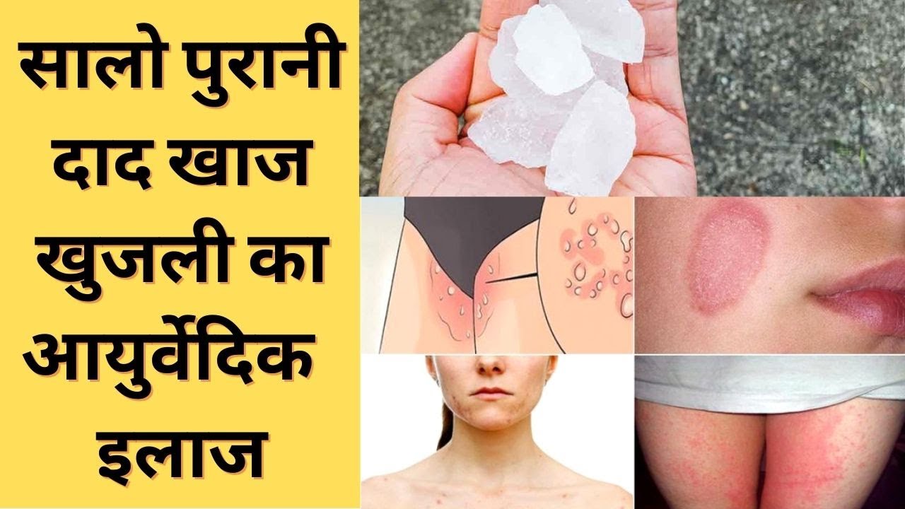 दाद खाज़ खुजली को 2 दिन में जड़ से ख़त्म करेगा Fungal Infection Home