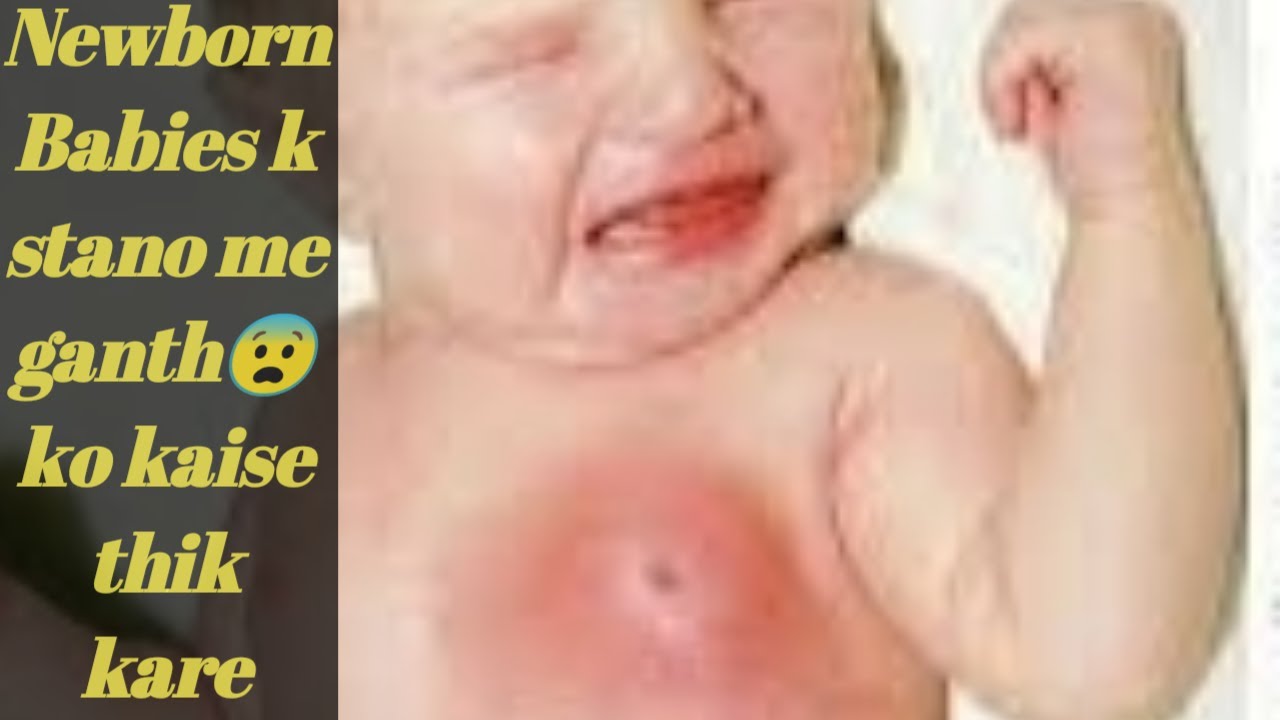 Neonatal Mastitis in Babies शश क सतन म गठ Swallon Breast in Infants kaise thik kare