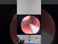 Shocking Sinus Suction Removal 🫣 | Endoscopic Nose Cleaning #Doctor #ENTClinic #Viral