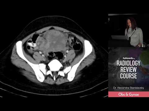 ovarian-torsion---radiology-review-course