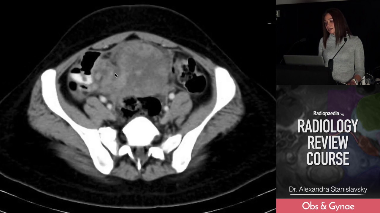 intermittent ovarian torsion