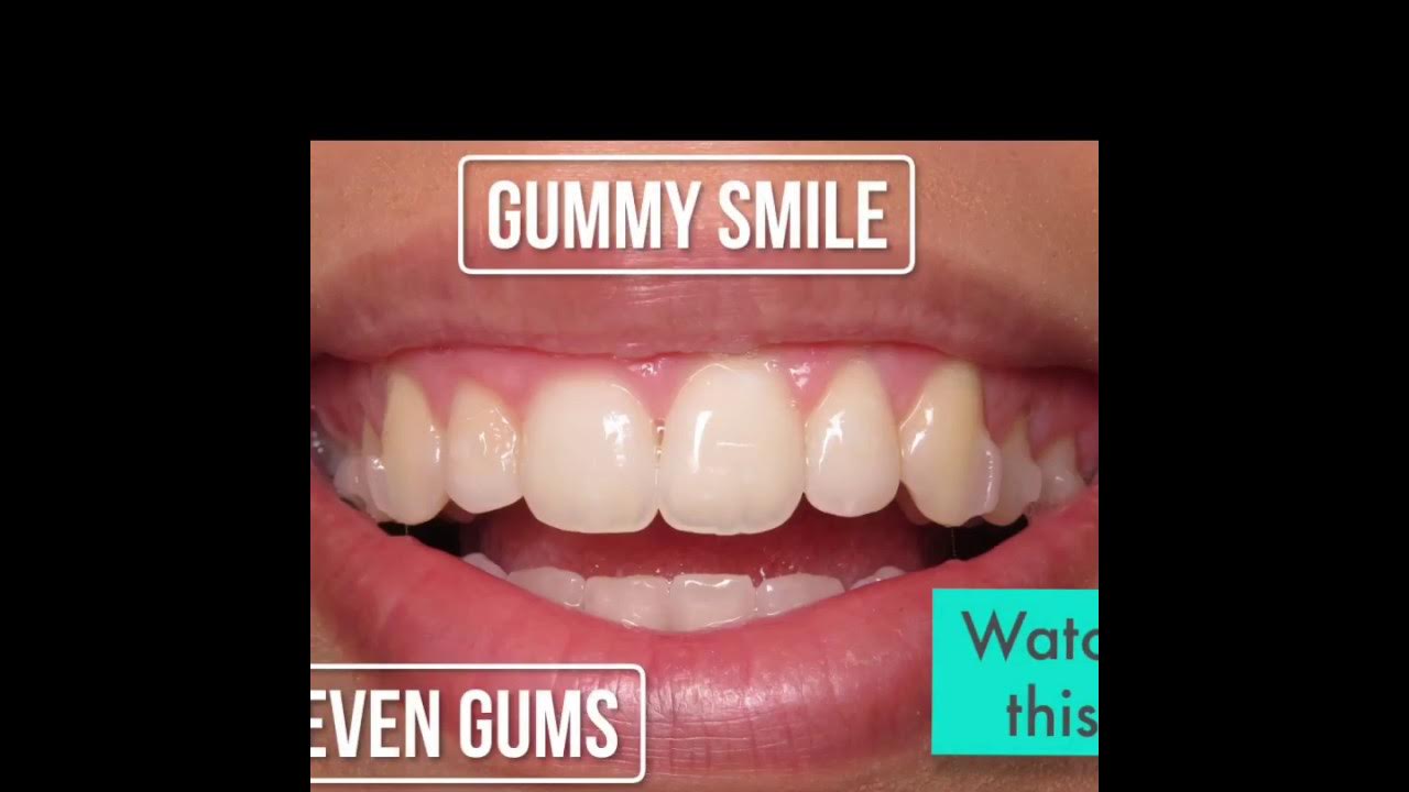 Gummy smile or uneven gums? Our Waterlase laser will fix it comfortably and without surgery