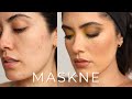 how I cover active breakouts, post acne marks and irritated skin..."maskne" | Melissa Alatorre