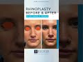 4 Months After Rhinoplasty and She’s Glowing ✨👃 | Dr. Becker