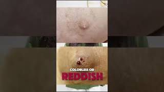 Early Signs of Breast Cancer You May Be Missing | Know the Warning Symptoms