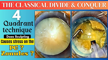 The Classical Divide & conquer 4 Quadrant technique.Does Sculpting Causes stress on the PC & Zonule?