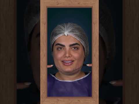 شوف الفیدیو للنهایة شفط اللغلوغ باقل من ساعه یمنحك زاویة دائمیة للفك