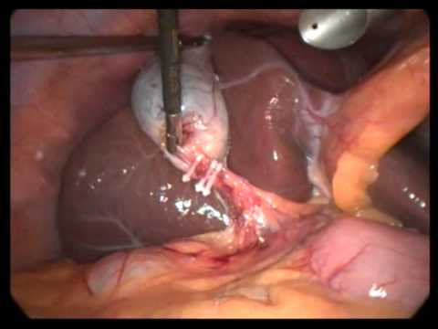 Lap  Cholecystectomy Unedited 250 Simple Chronic Cholecystitis With Omental Adhesion