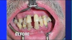 Teeth ~ No Dentures Dental Implants - Living Healthy Chicago 