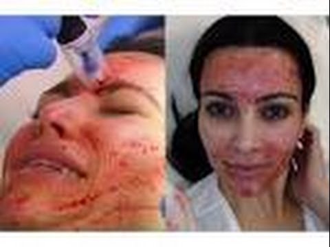 Ondas dar a entender Romper PLASMA EN EL ROSTRO (MI EXPERIENCIA) - YouTube