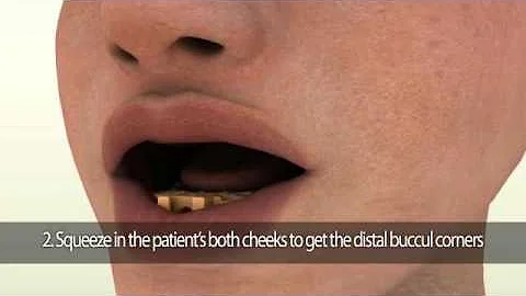 Pala Digital Dentures Instructional Video