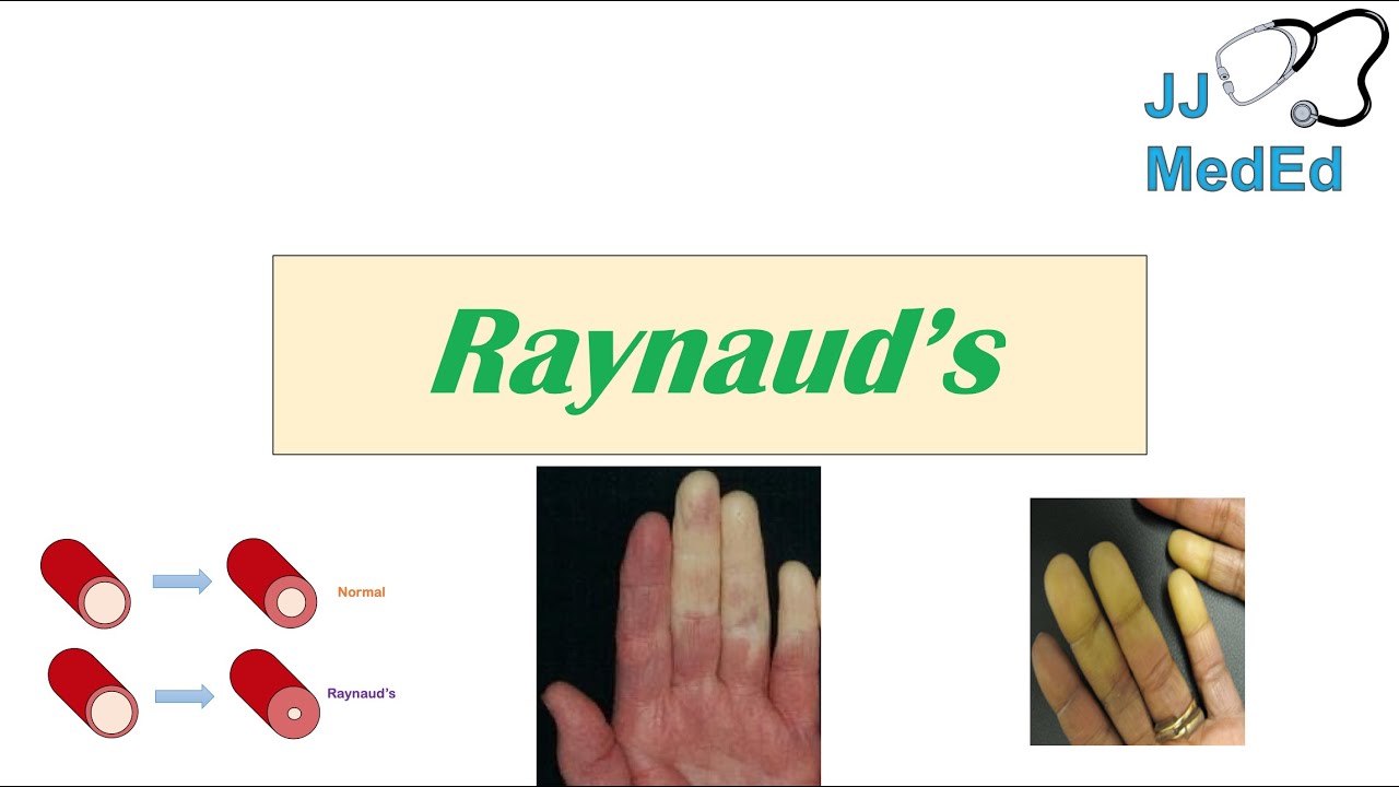 Introduction To Raynaud’S Phenomenon (Syndrome) | Pathophysiology, Triggers, Symptoms, Treatment