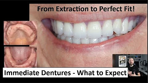 From Extraction to Perfect Fit - the Immediate Denture Journey