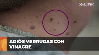 ✅ Remedio natural para ELIMINAR VERRUGAS  con vinagre de manzana | Salud180 🌿