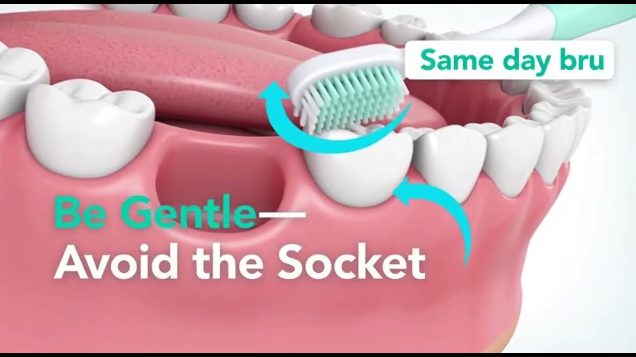🦷 Can You Brush Your Teeth After Wisdom Tooth Removal?