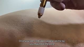 CryoIQ Cryotherapy Device Applications with Captions screenshot 4