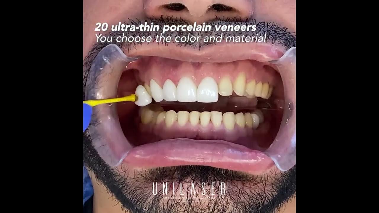 porcelain veneers