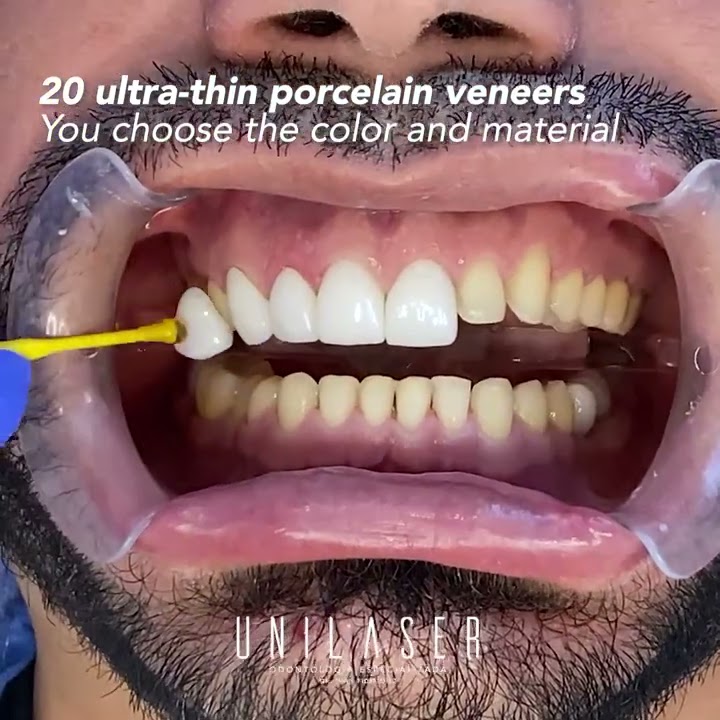 Porcelain veneers. This is how we do it