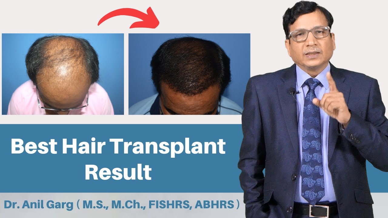 Planning a hair transplant 5 expert tips you should keep in mind   TheHealthSitecom