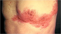 Herpes Zoster Ophthalmicus Rash On Stomach Shingles In Pregnancy