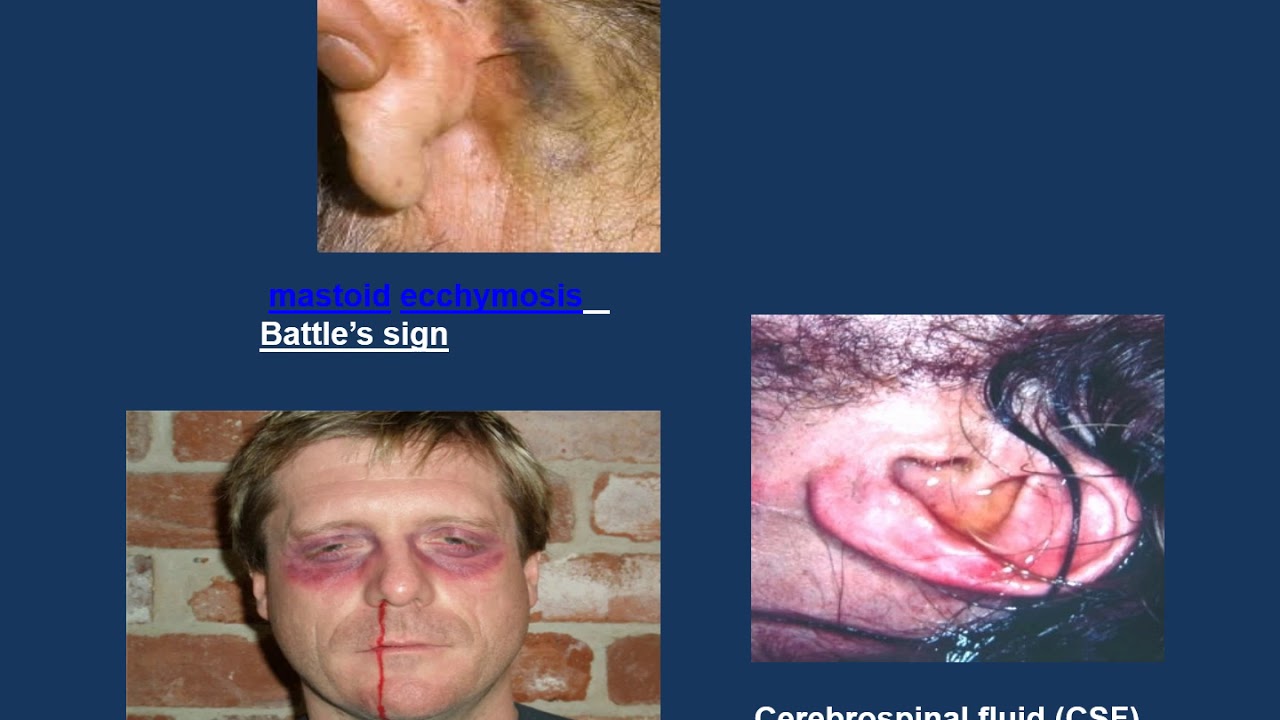 head injuries part 2 - YouTube