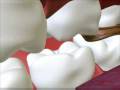 Dental cavity  3d medical  animation