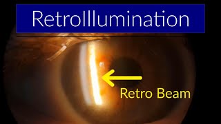 RetroIllumination - Slit Lamp Techniques