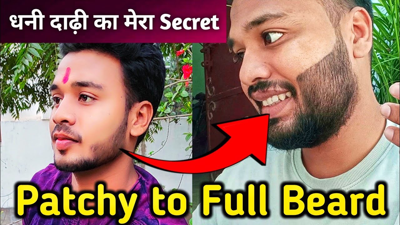 patchy-beard-to-full-beard-patchy-beard-growth-dadhi-ghana-kaise