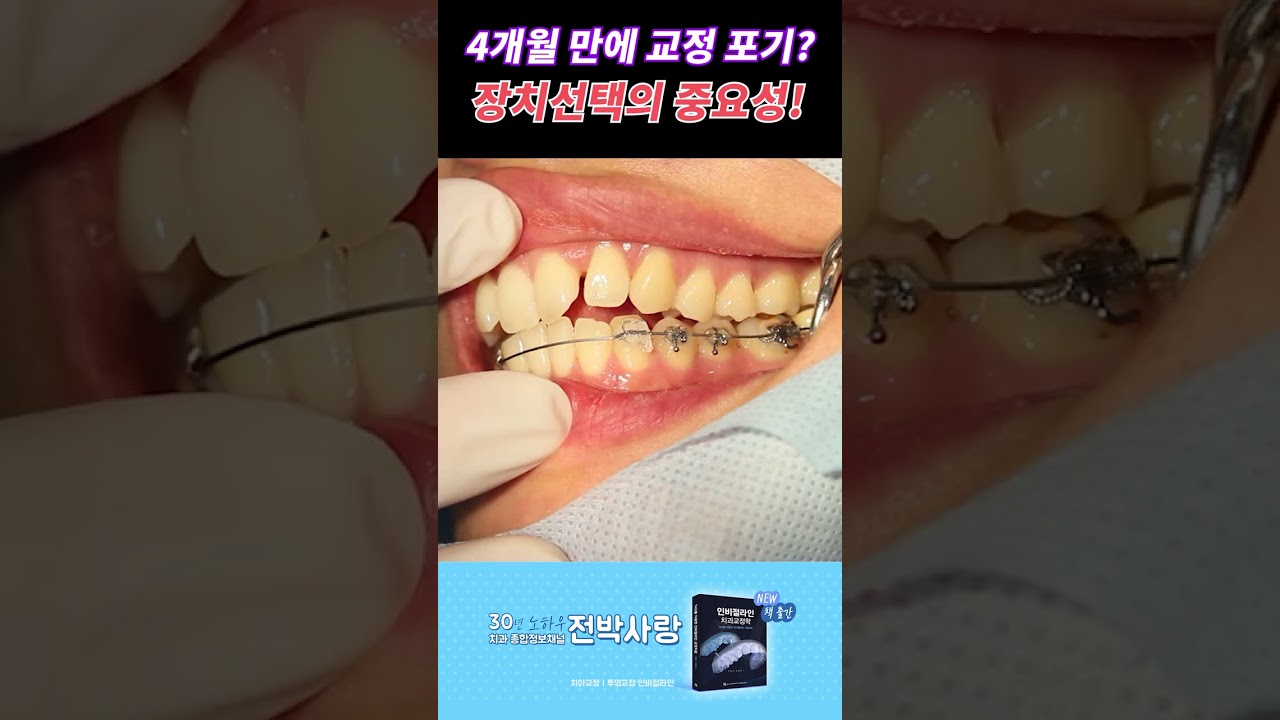 4개월만에 철사교정 포기!