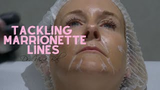 Marionette Lines Filler Before and After at the Facial Sculpting Clinic by Dr Nina Bal