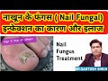 नाखून की फंगस इन्फेक्शन का ईलाज (हिंदी में) | Fungal Infection in Nail Cause Symptoms and Treatment