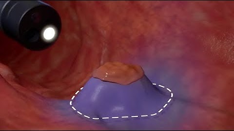 Eleview™ Mechanism of Action