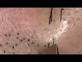 【毛抜き職人Classic】【Plucking facial hair】ずっと見ていられる美肌のヒゲ抜き 【2018 7 22公開作品の再録です】(アゴヒゲ編⓶)