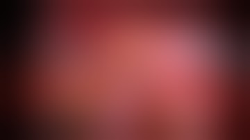 Robotic total mesorectal excision (RTME)