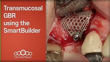Transmucosal GBR using the SmartBuilder - [Dr. Kim Yongjin]