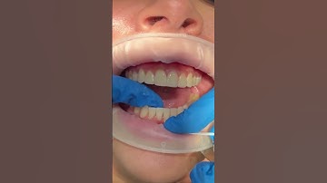 Maintaining composite bonding using our composite conditioning process ™️🤍  #shorts