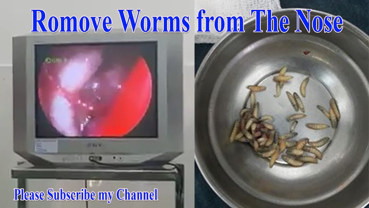 Worms In Human Nose Video Shows Doctors Removing 67 Worms From Nose Youtube 